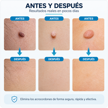 Kit Removedor de Acrocordones – Eliminación Fácil y Precisa en Casa